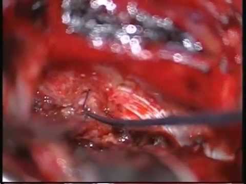 Vestibular schwannoma resection