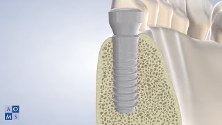 Zirconia Dental Implants in Amarillo, TX | Amarillo Oral & Maxillofacial Surgery