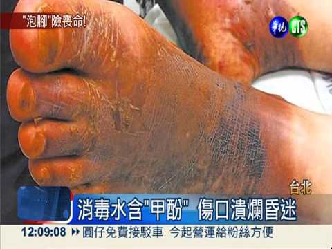 泡消毒水治香港腳 男子險喪命
