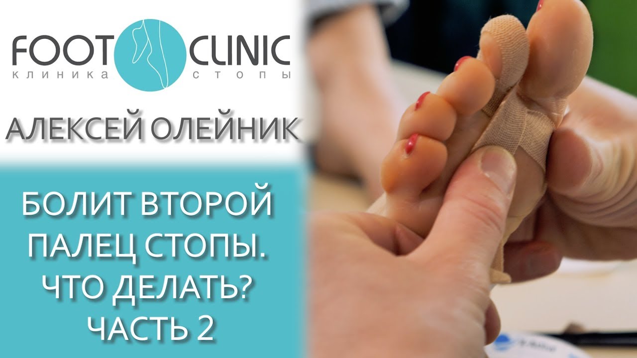 Молоткообразная деформация  2-го пальца. Часть 2.