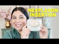 Nexplanon Implant Insertion Everything You Should Know