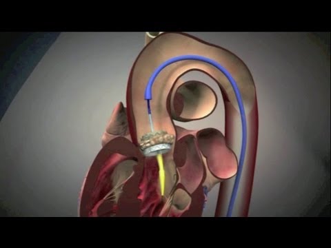 Transcatheter Aortic Valve Implantation (TAVI)