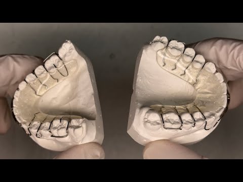 Tipps Zahntechnik #KFO Workshop: Herstellung einer Retentionsplatte mit verkleidetem Labialbogen.