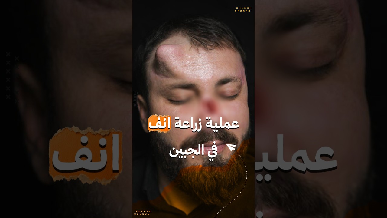 فيديو | طبيب عراقي ينجح في زراعة أنف مريض في جبهته بعد تعرضه لصعقة كهربائية