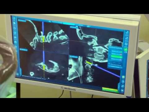 3D透視ベースのナビゲーションを用いたアトアトアキシャルフュージョン (Atlantoaxial fusion assisted by 3D fluoroscopy-based navigation)