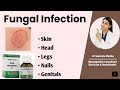 fungal infection treatment in homeopathy |  homeopathic medicine for fungal infection, ringworm
