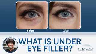 What is Under Eye Filler?