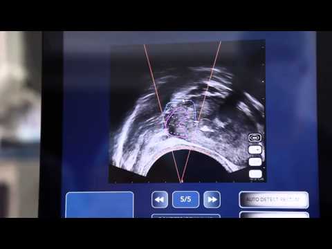 Prostate Übungsbehandlung Rote Drachen von Prostatitis