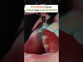3 Benefits Of Dental Scaling Polishing Bestkidsdentist Dentist Dental Dentalcare