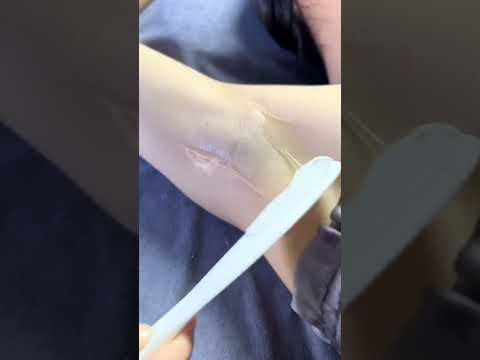 Hair Removal in Poipet