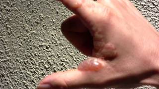 Poison Ivy Allergic Reaction ★ Rash & Blisters draining- Poodle-dog Bush (Common turricula) ♦