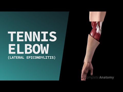 Tennis Elbow (Lateral Epicondylitis)