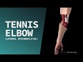 Tennis Elbow Lateral Epicondylitis