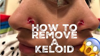 How I Removed My Nose Piercing Bump (keloid)