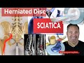 3 Things To Know About SCIATICA Or BACK PAIN Due To A HERNIATED DISC Neurosurgeon Explains