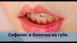 Анализ на половые инфекции — Сифилис и болячка на губе. — фото