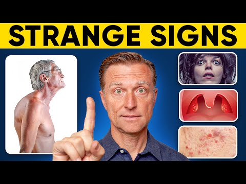 23 WEIRD Vitamin D Deficiency Symptoms