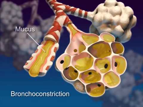 Asthma: Learn@Visible Body