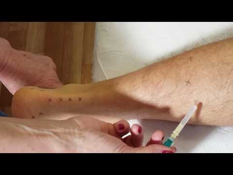 ízületi tendinosis kezelés akut artrosis a kezek kezelésében
