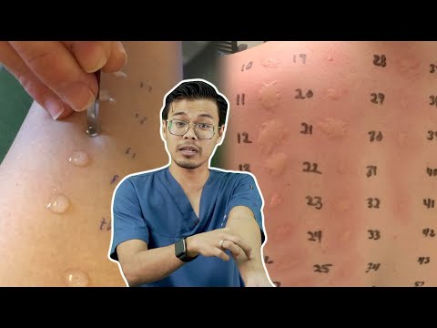 Buat Test Ni Kalau Nak Tau Alergik Apa?