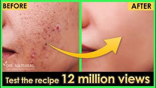 In 3 DAYS, How to Remove Acne Scars, Dark spots, Black spots and Uneven skin tone.
