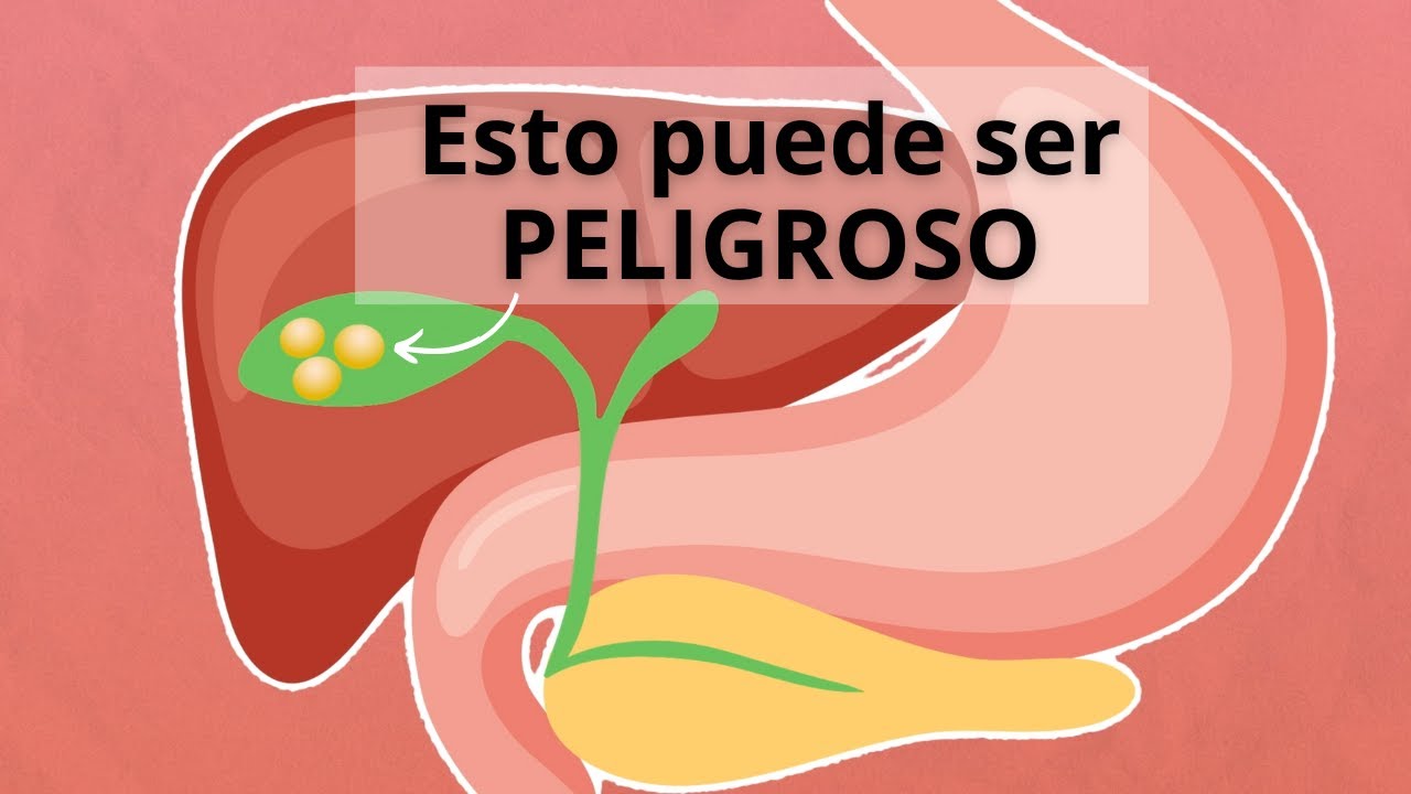¿Qué son los cálculos biliares? - Enterarse