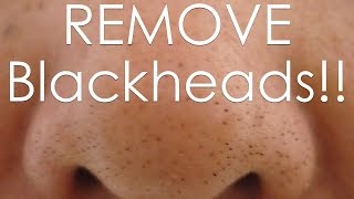 DIY how to REMOVE Blackheads Using an EGG!!
