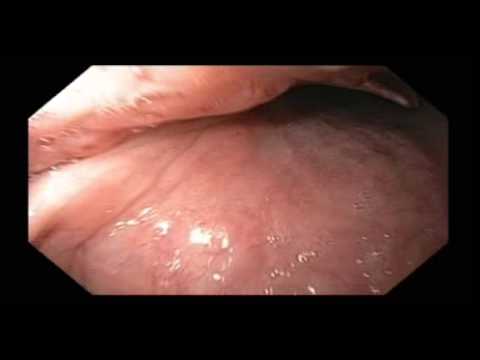 Epiglotitis viral y edema supraglótico