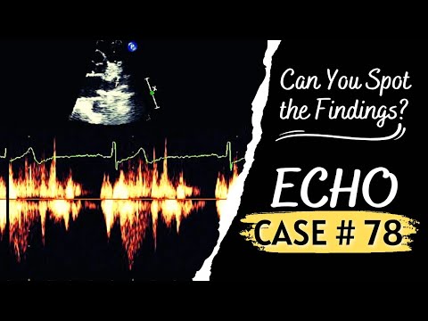 ECHO CASE 78 | Echocardiography Spot Diagnosis Series | Echocardiogram Interpretation