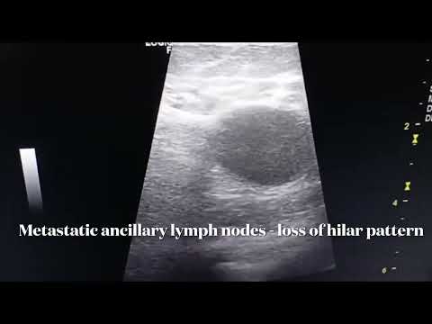 BIRADS 5 - Highly suggestive of malignancy - Malignant breast lesion+axillary lymphnodes metastasis