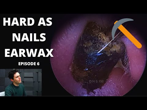 Hard As Nails Ear Wax EPISODE 6