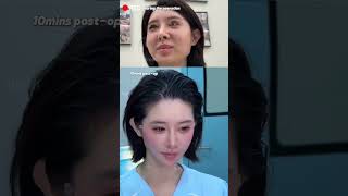 Download lagu #9Dfacelift#Facelift#smilelines#FacialRejuvenationSurgery mp3