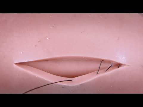 Subdermal suture stitch