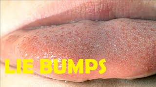 how to get rid of lie bumps on your tongue overnight