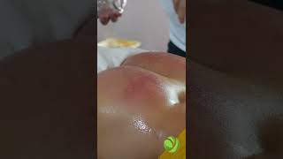 Download lagu Nyeri punggung bawah akibat Terapi Bekam ASMR mp3