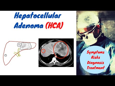 Hepatocellular Adenoma | Liver Cell Adenoma | HCA