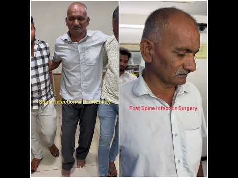 Spine Surgery Gave Him His Life Back | Dr. Ajay Kothari