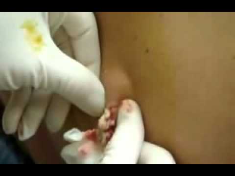 comment soigner bouton bcg