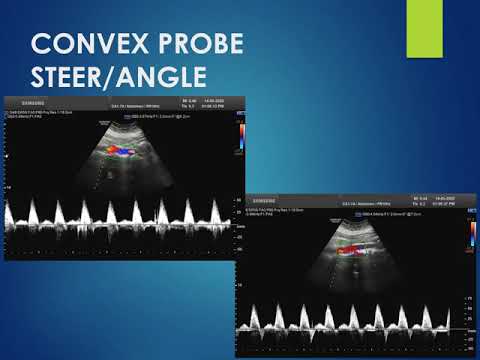 Spectral Doppler Settings  Dr Prashant Onkar