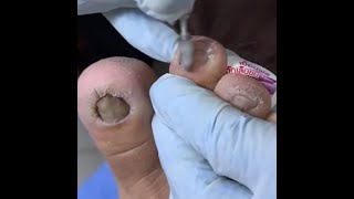 Ep_8170 Foot nails skin removal 👣 If you're free, come and wait for your nails 😄 (clip from Thail...