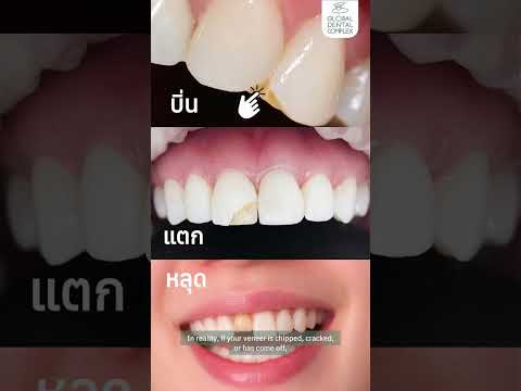 วีเนียร์ บิ่น แตก หลุด จัดการได้ใน 2-3 ชั่วโมง