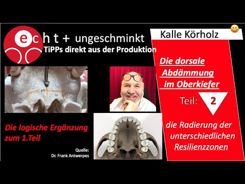 Die dorsale Abdämmung im Oberkiefer Teil 2