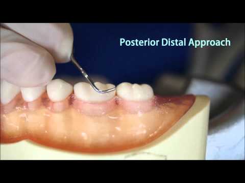 How to use Gracey Curette 13-14(그레이시큐렛 13-14 사용)