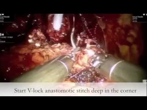 Anastomosis In Robot-Assisted Prostatectomy