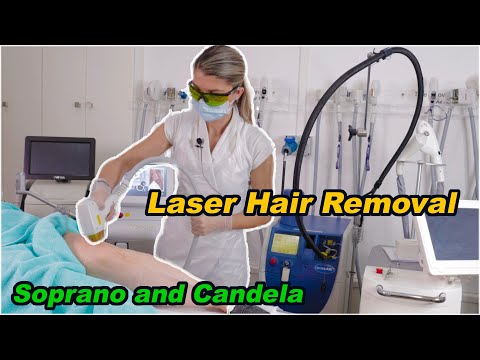 Laser Hair Removal - using Soprano Ice Platinum Laser...