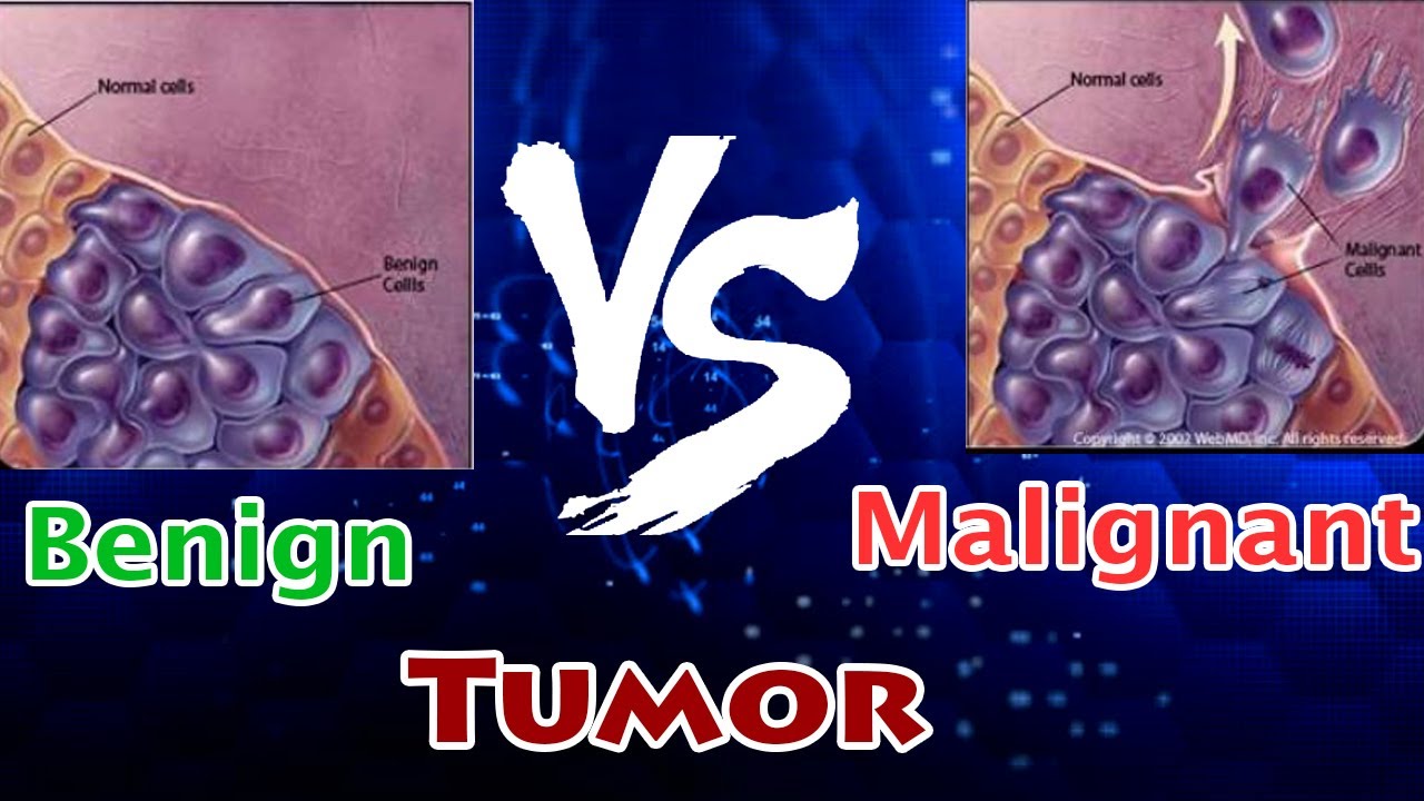 Benign Tumor Vs Malignant Tumor ( Clear Comparison )