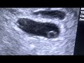 A single embryo SPLITS! Early identical twin findings at 5 & 6/7 weeks gestation.