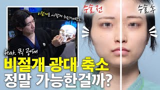 비절개 광대축소술, 정말 가능한가요? 😮 👉🏻성형외과 전문의가 솔직히 알려드립니다👈🏻