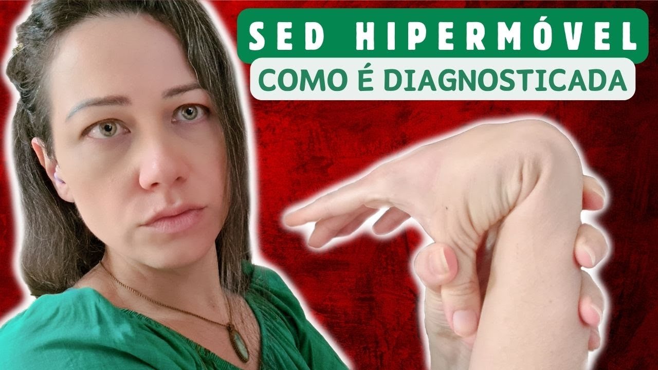 CRITÉRIOS da Síndrome de Ehlers-Danlos de 2017 e Meu Diagnóstico