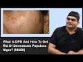What Is DPN And How To Get Rid Of Dermatosis Papulosa Nigra ClearSkin Pune In HINDI